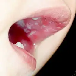  一般出现鹅口疮会有什么症状