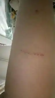  5天前坐电动车,下车的时候小腿被铁的划伤了,当时就红红的一条印子没流血晚上时候发现结痂了,伤口很