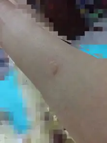  问半年多半手被油溅到,起了水泡,好了之后留下印子,之后每隔段时间在那个印子上又会起个包,好像蚊子