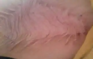  有品味,没异味浅谈腋臭的治疗
