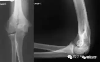  42张x线片带你读懂不同部位骨折