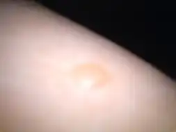  腿上长了个包,怎么办啊