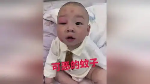 孩子被蚊子叮了肿图片