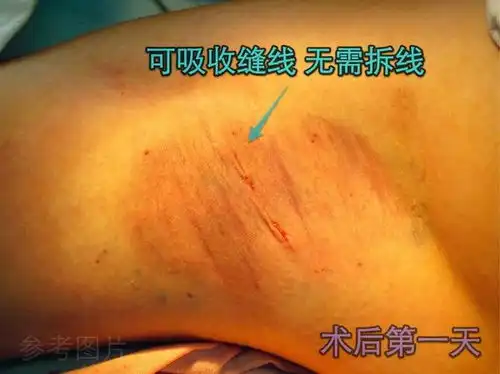  腋臭微创手术转载