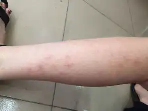  腿上长很多类似蚊子咬的包,但又不是蚊子咬的,请问这是什么