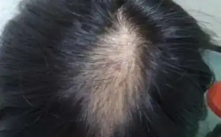  为什么男性更容易比女性脱发
