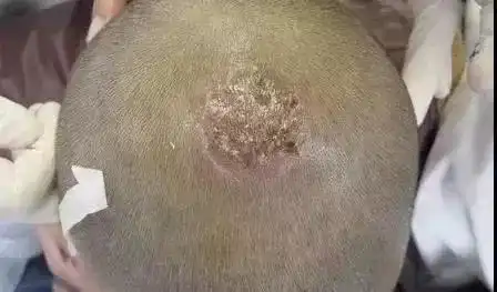  头皮瘙痒,可能是癣在作怪