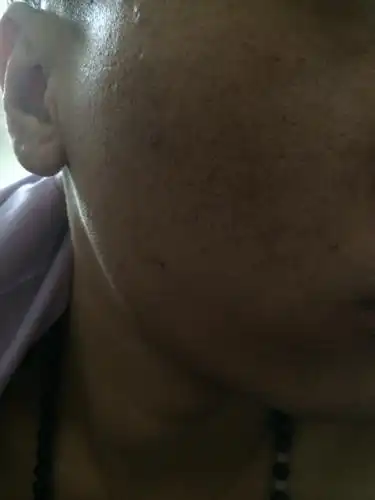  脸上挤出来的有芝麻一样的颗粒,也有白色长条,这是什么怎么治疗