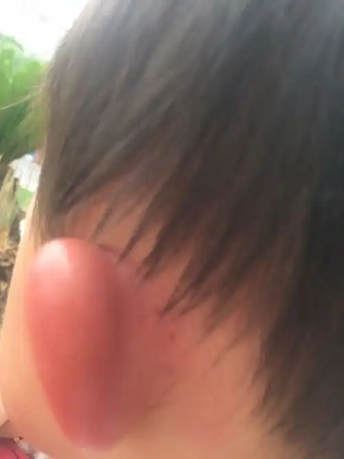  宝宝被蚊子叮咬,又肿又痒还留疤,应如何处理正确的做法可收藏