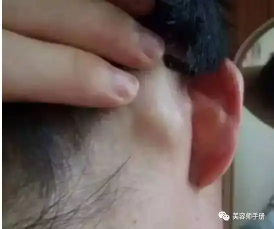  淋巴癌是怎样形成的