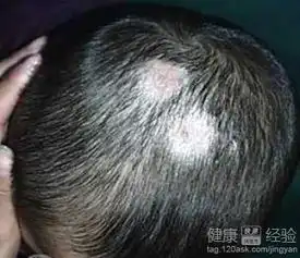  头癣与脂溢性皮炎的区别