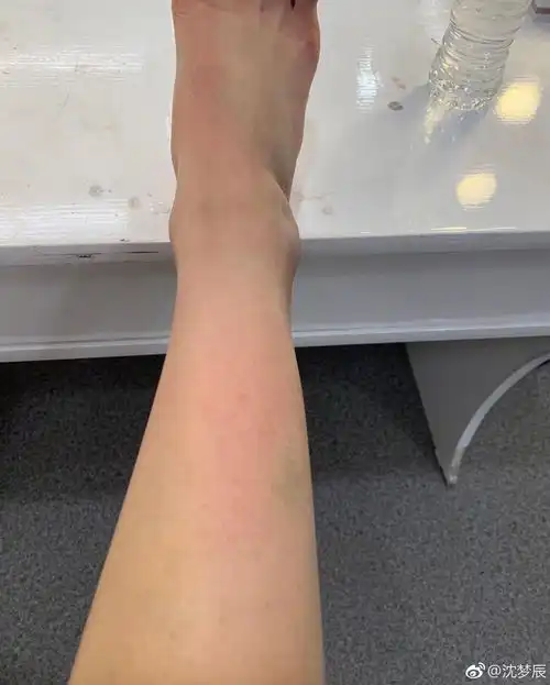 沈梦辰穿薄纱裙室外主持,倪萍老师给暖手,还是冻到皮肤过敏
