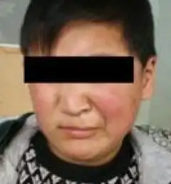  求治疗面瘫方法有哪些