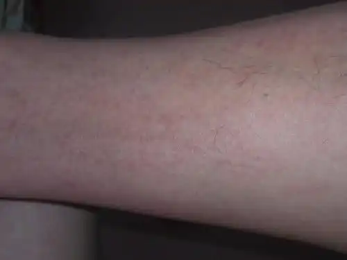  小腿皮肤好痒痒