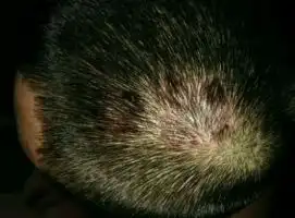  烟台患上头癣的症状是什么样的