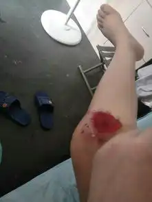  腿上的创伤去医院医生说不用包扎给开了盒百多邦为什么擦了百多邦之后伤口一直流水