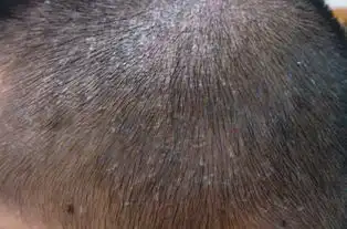  我头上有很多大块的头皮屑是什么问题