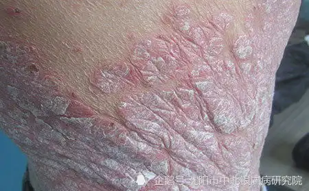  沈阳中北牛皮癣医院牛皮癣的早期症状大盘点