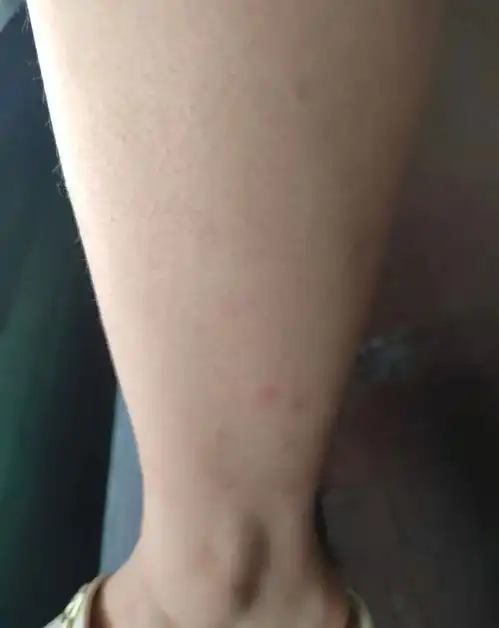  密密麻麻,奇痒无比不少杭州人已经中招,比蚊子还可怕