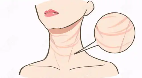 颈纹拉皮手术过程图解,瞧瞧做完颈部拉皮手术能维持多少年  颈纹拉皮手术过程图解,瞧瞧做完颈部拉皮手术能维持多少年