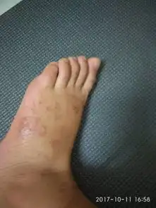  在泰国被蚊子咬了起水泡很痒