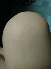  福建有登革热吗这是做什么蚊子咬的