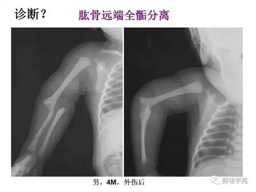  儿童骨骺损伤影像诊断