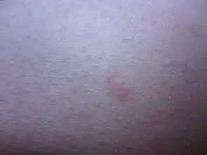  冬天小孩小腿腰间长一些像蚊子咬的包包是什么