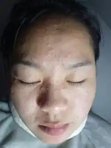  脸最近有很多痘痘,怎搞啊