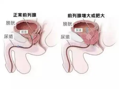  尿频夜尿增多难道真的是前列腺增生搞得事