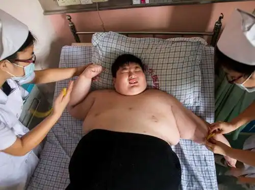 小胖威利综合征