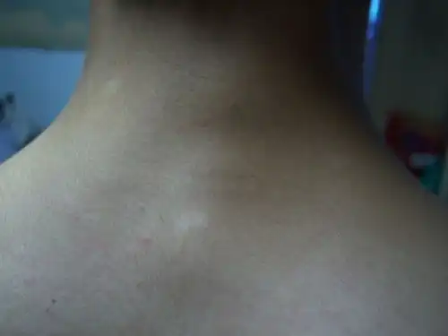  脖子后面出现几个白斑,不痛不痒没任何感觉,求解这是怎么回事