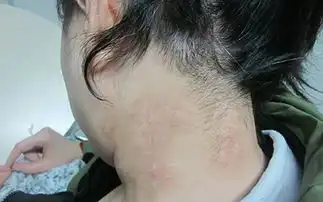  小孩身上有白点白癜风早期症状图片