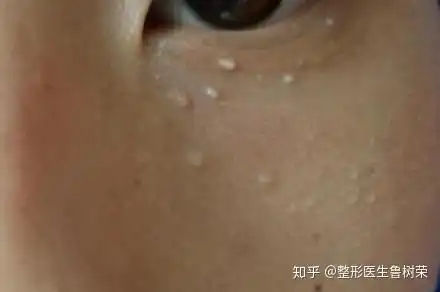  脂肪颗粒是什么样子