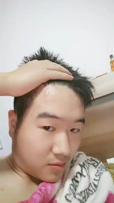  额头有伤疤今年征兵体检能通过吗有什么解决方案