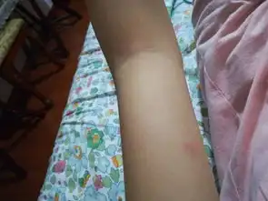  红点不痛不痒像蚊子咬的一样