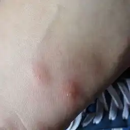  身上突然长了好多像蚊子叮的包,肿好大好痒,消不下去