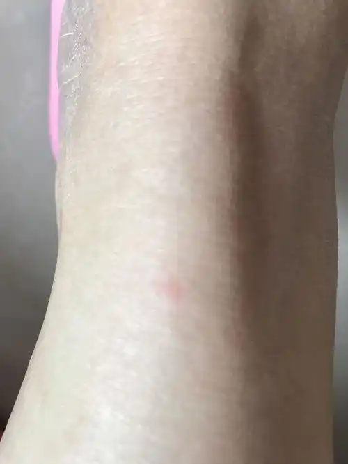  15到25分钟前腿上被蚊子叮包,后去门卫取快递,他家狗闻了我咬的包附近,如果鼻子碰到包会得狂犬病吗