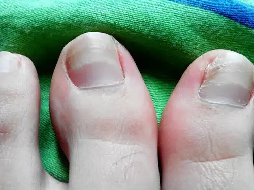  最简单的灰指甲护理方法,看完再也就不怕灰指甲了