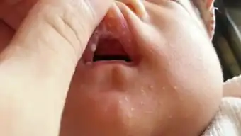  鹅口疮临床表现鹅口疮的症状是什么有来医生