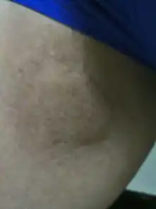  莫名其妙的出现的有一点点痒之后才发现这里肿了跟蚊子咬了以后放