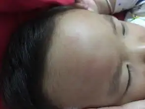  被蚊子咬了怎么会肿这么大