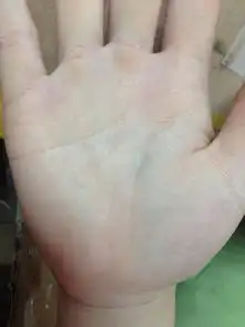  女,看手相,谢谢,手指肚很鼓,鼓起一个小包