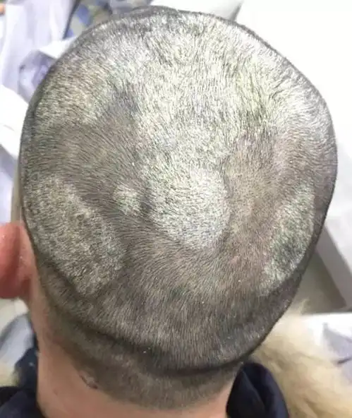  什么是头癣头癣分为哪几种怎样治疗头癣不复发
