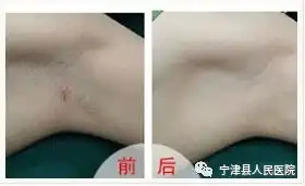  远离尴尬腋下烦恼,治疗腋臭新方法