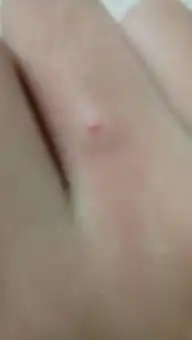  两三天前出现的包包,又痒又有点痛,像是蚊子咬的可以前又不这样,喷花露水之后会舒服一点可是过一会儿又