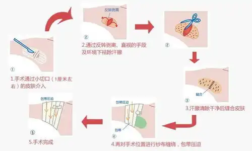 腋臭手术切口设计图片