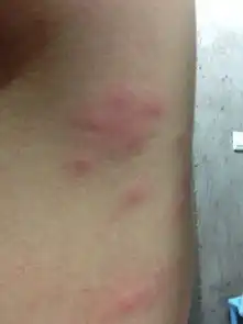  身上长了好多像蚊子咬的包很痒怎么回事