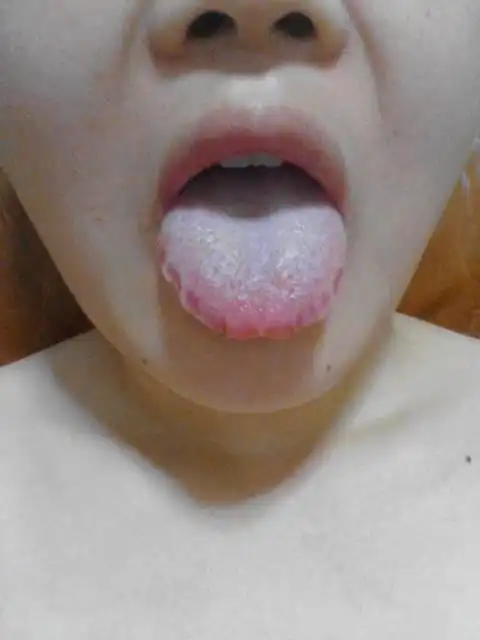  看看神奇的舌诊,可通过舌头治上火