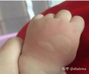  驱蚊神器推荐驱蚊神器紫草膏驱蚊神器灭蚊灯被蚊子咬了之后快速消肿的好方法